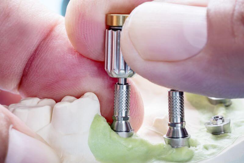 diş implantında nelere dikkat edilmelidir? Fiyatları Antalya