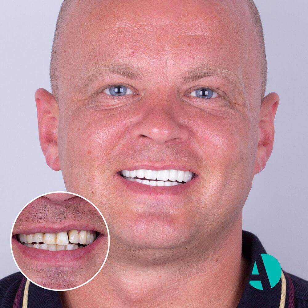 Dental-implant-Turkey-1