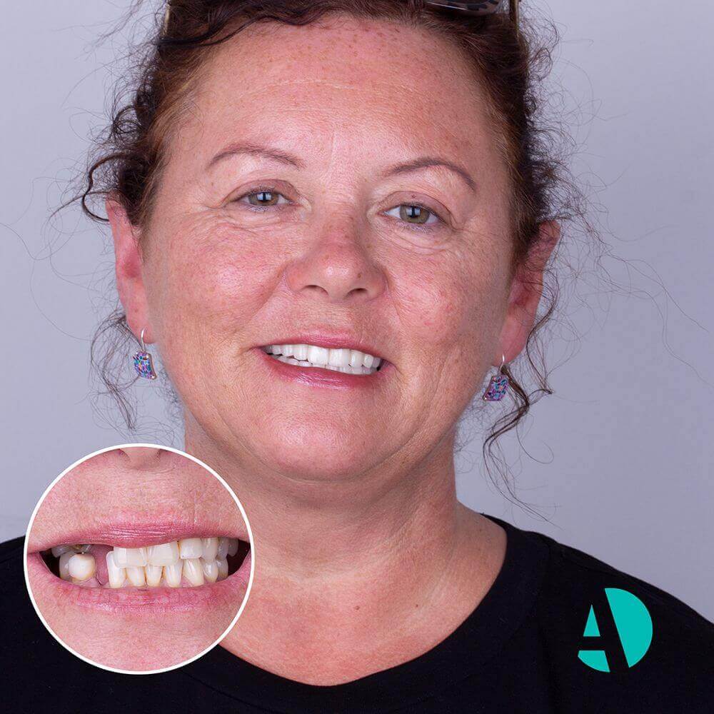 Dental-implant-Turkey-4