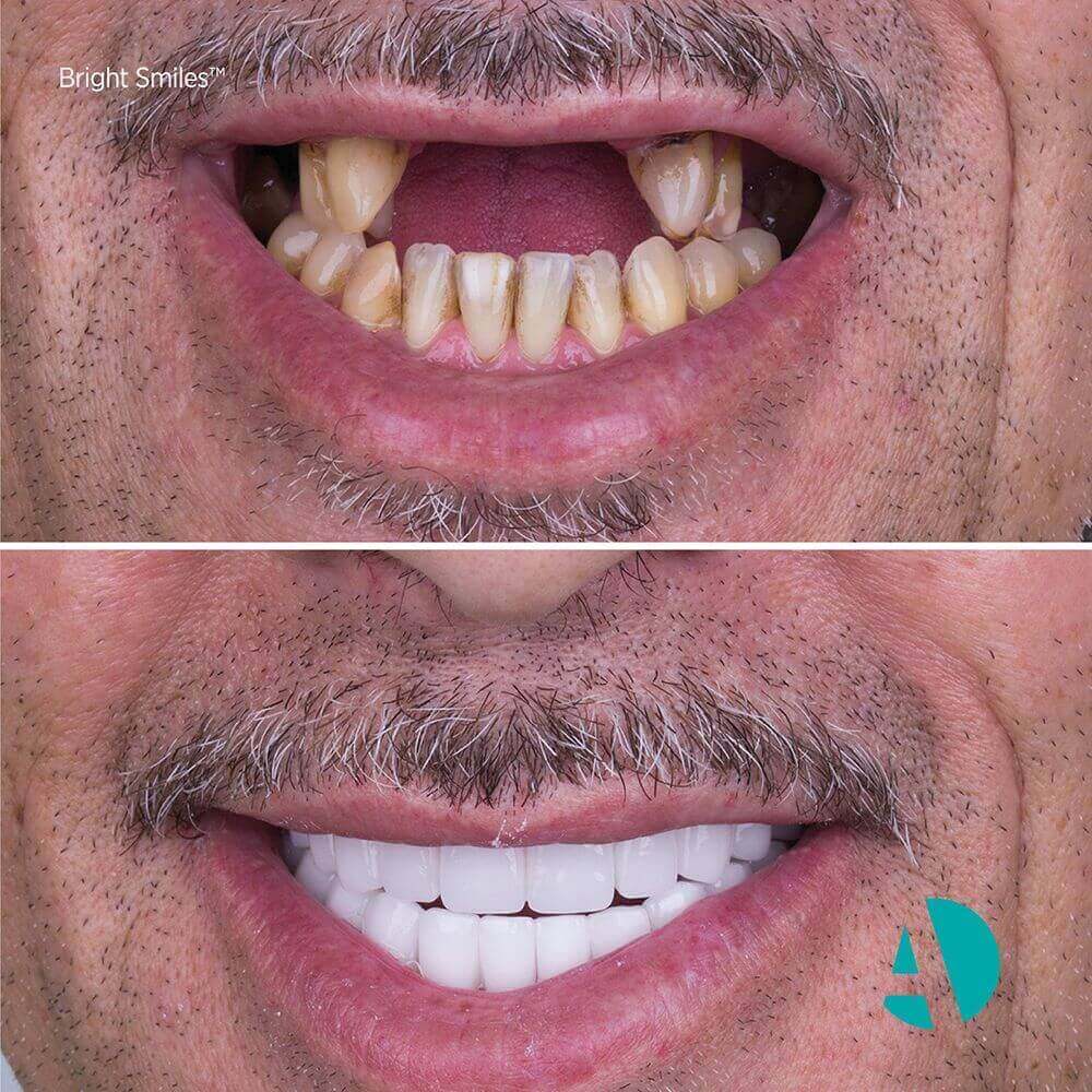 Diş İmplantı İle Mükemmel Sonuç, diş implant tedavisinde kaç implant kullanılır? Fiyatları, Antalya