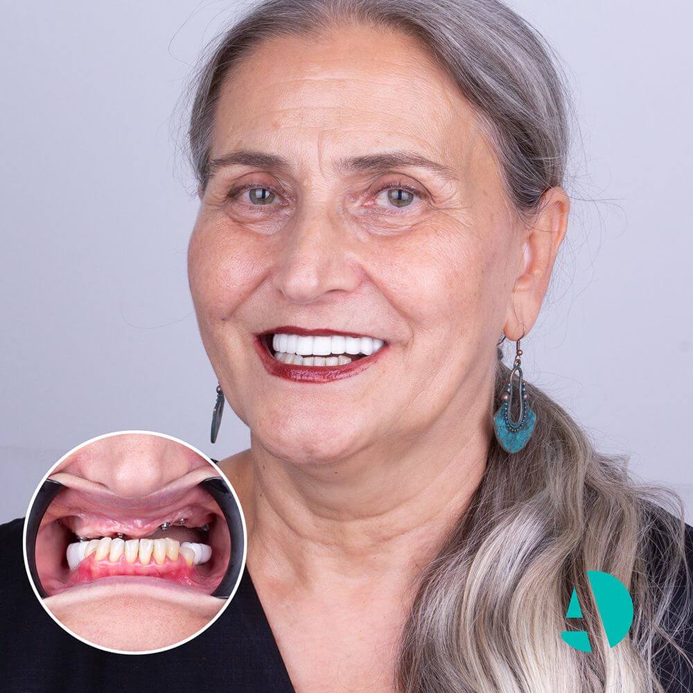 Full Dental Implants before after image taken in Turkey