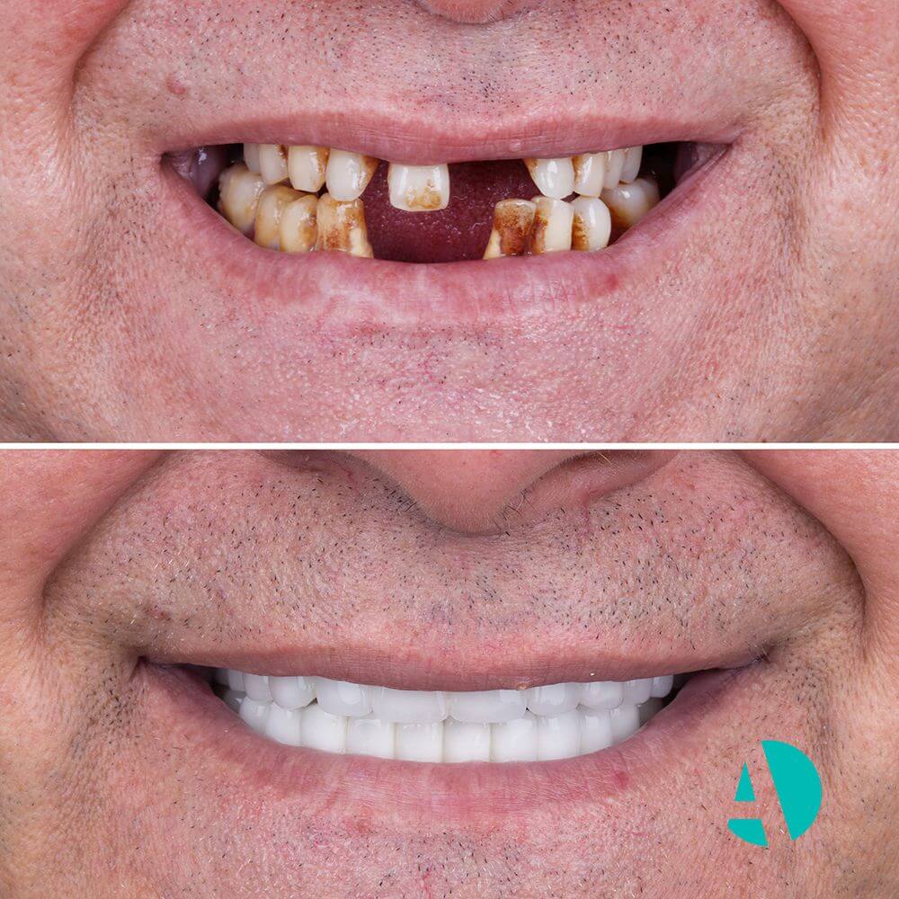 Full Dental Implants before after image taken in Turkey