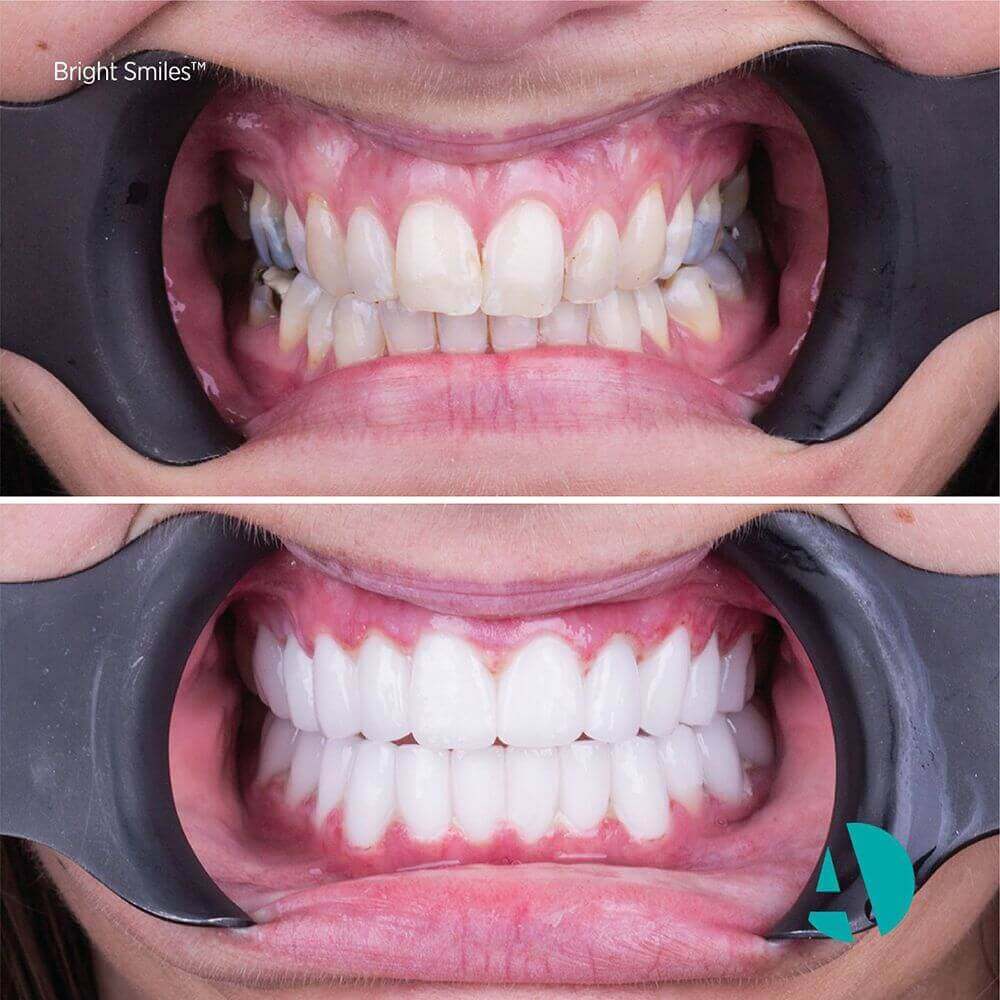 Dİş İmplant Tedavisi İle Sağlıklı Gülüşler,diş implant tedavisi fiyatları, Antalya