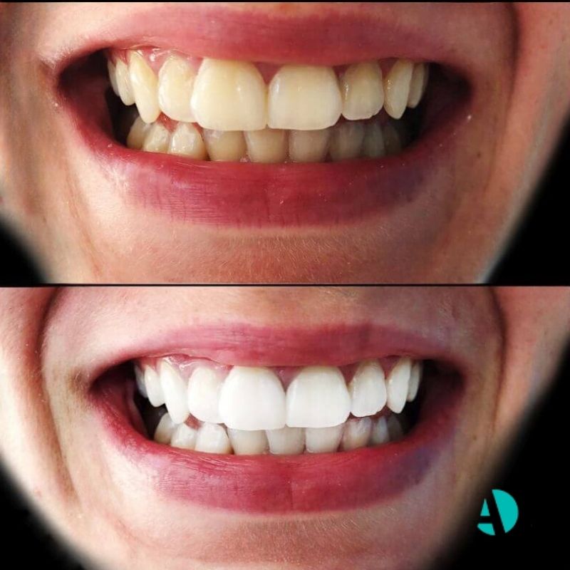 Teeth Whitening before after antalya turkey