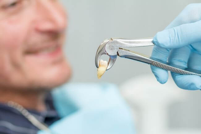 Yirmilik diş çekimi, nasıl yapılır? Çene cerrahisi fiyatları Antalya