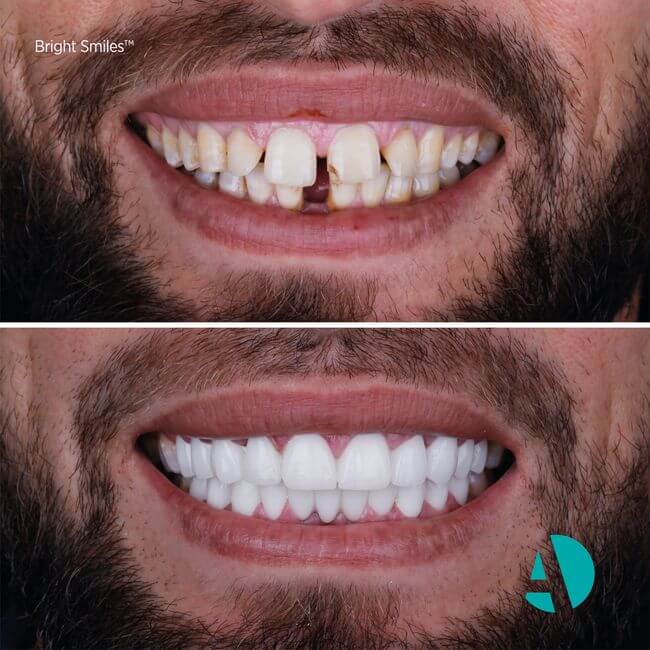 types of veneers before after image