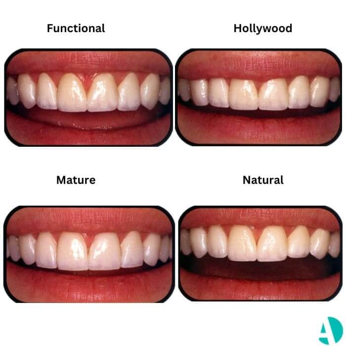 types of veneers second collection