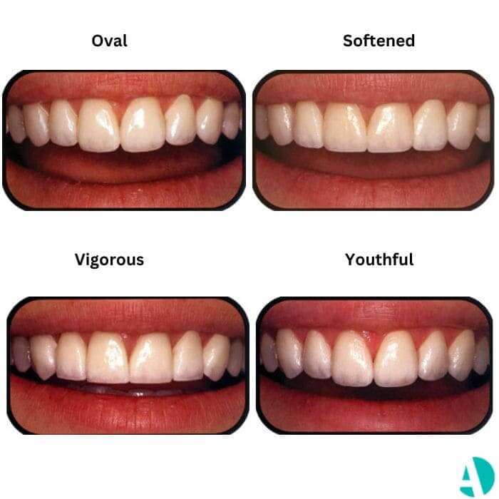types of veneers third collection