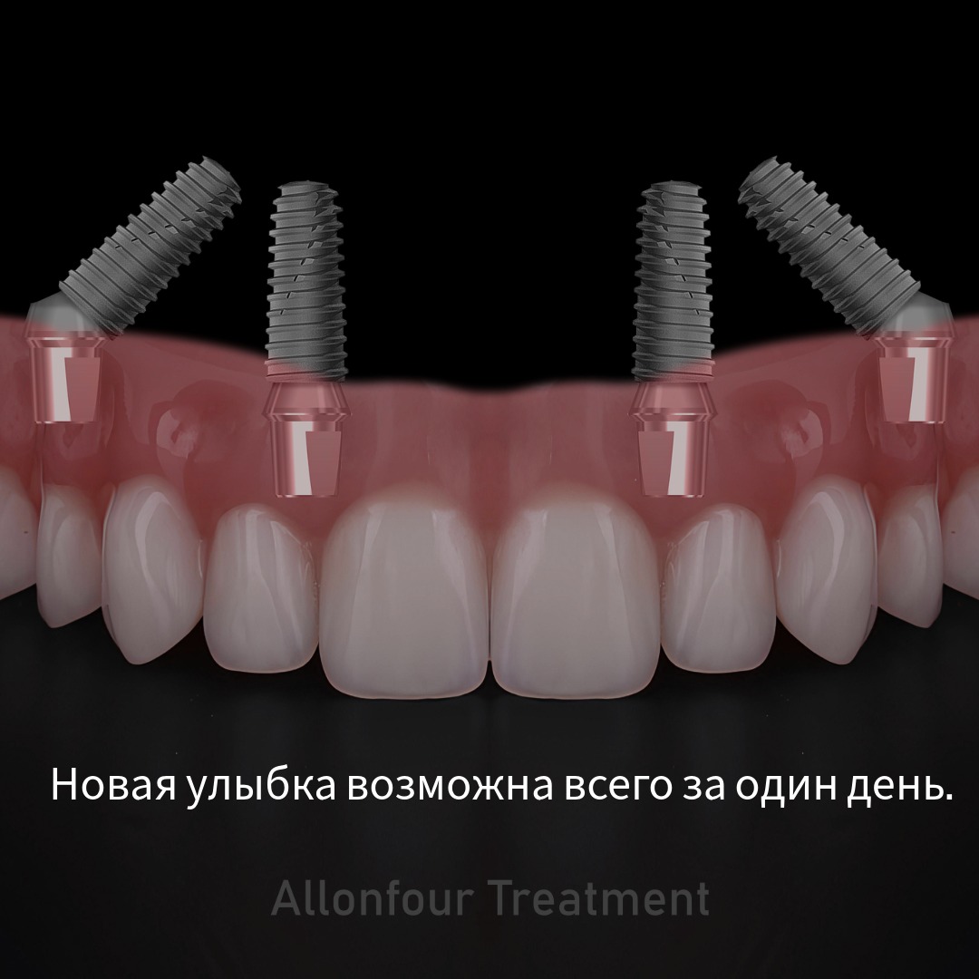  новая улыбка за 1 день — что такое All on 4?