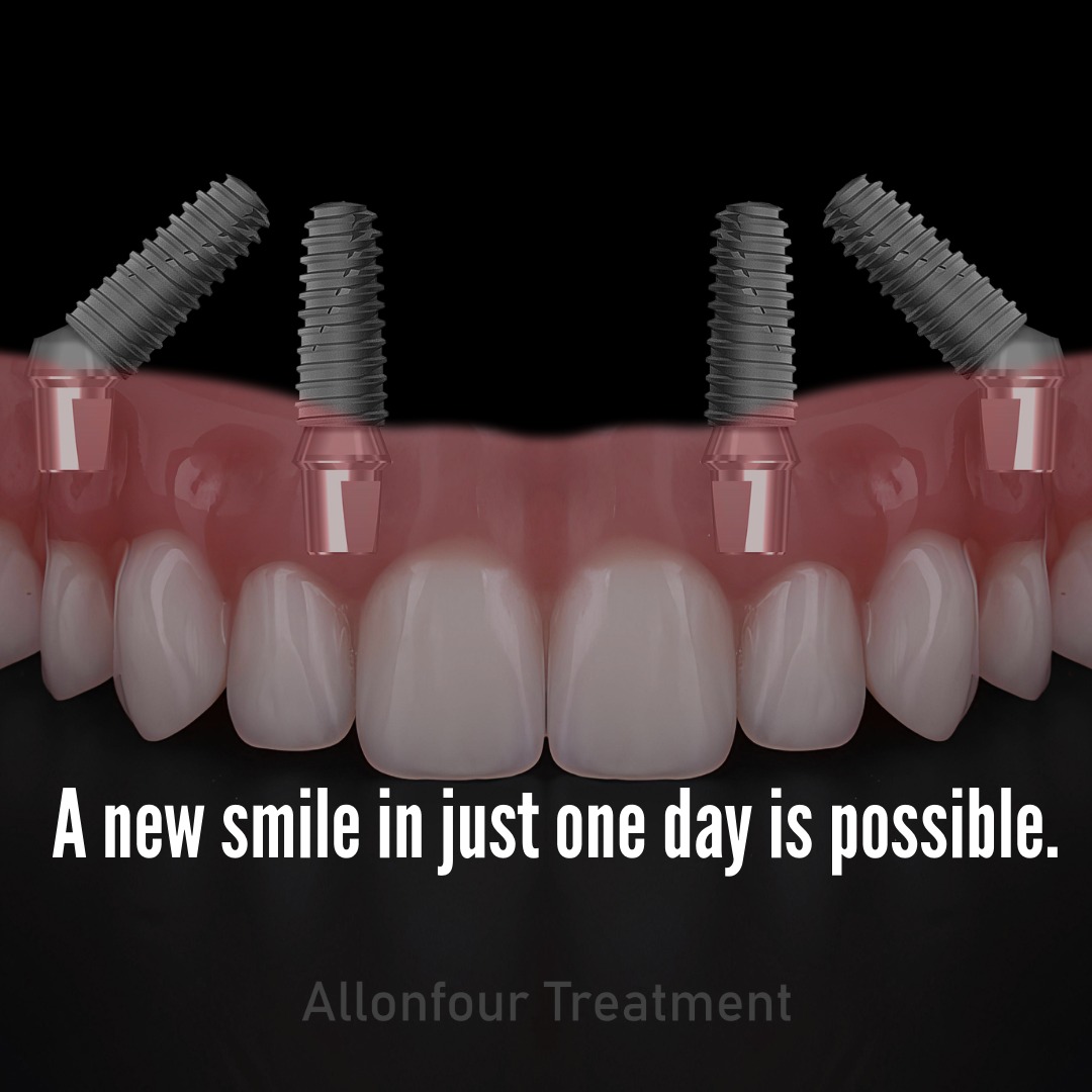 A New Smile in One Day, Even If You Have No Teeth: All-on-4