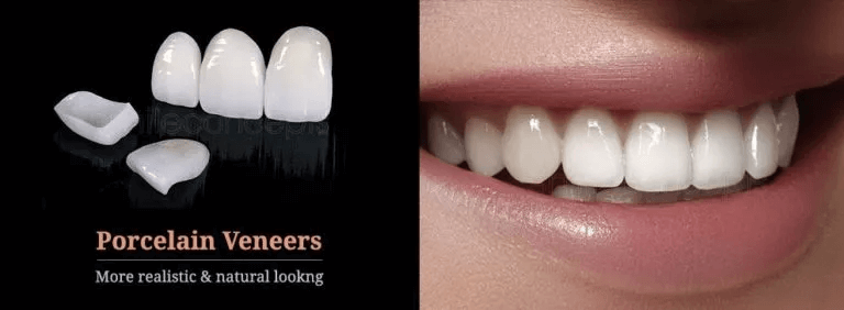 Porcelain Veneers: Longevity, Customization, and Application Process