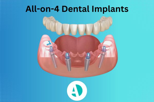 All-on-4 dental implants all on 4 dental implants Antalya