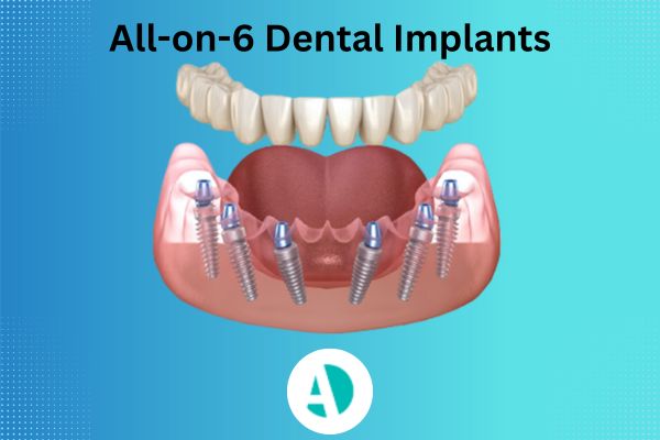 All-on-6 dental implants all on 6 dental implants Antalya