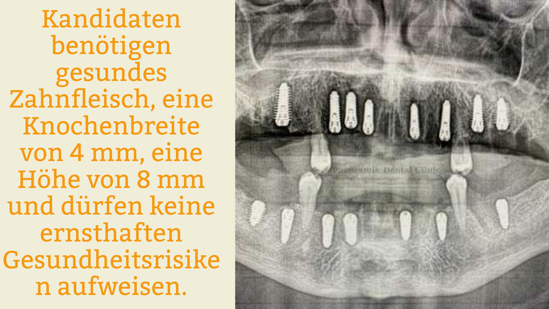 Wer ist ein geeigneter Kandidat für All-on-8? Wer ist ein geeigneter Kandidat für All-on-8?