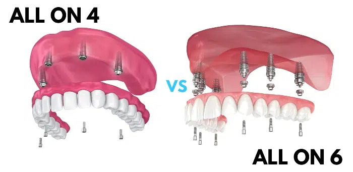 Composite vs Porcelain Veneers