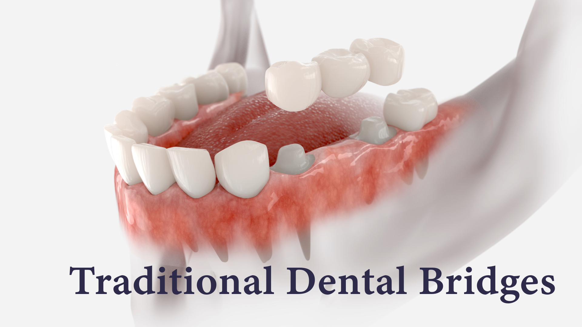 Traditional Dental Bridges Traditional Dental Bridges