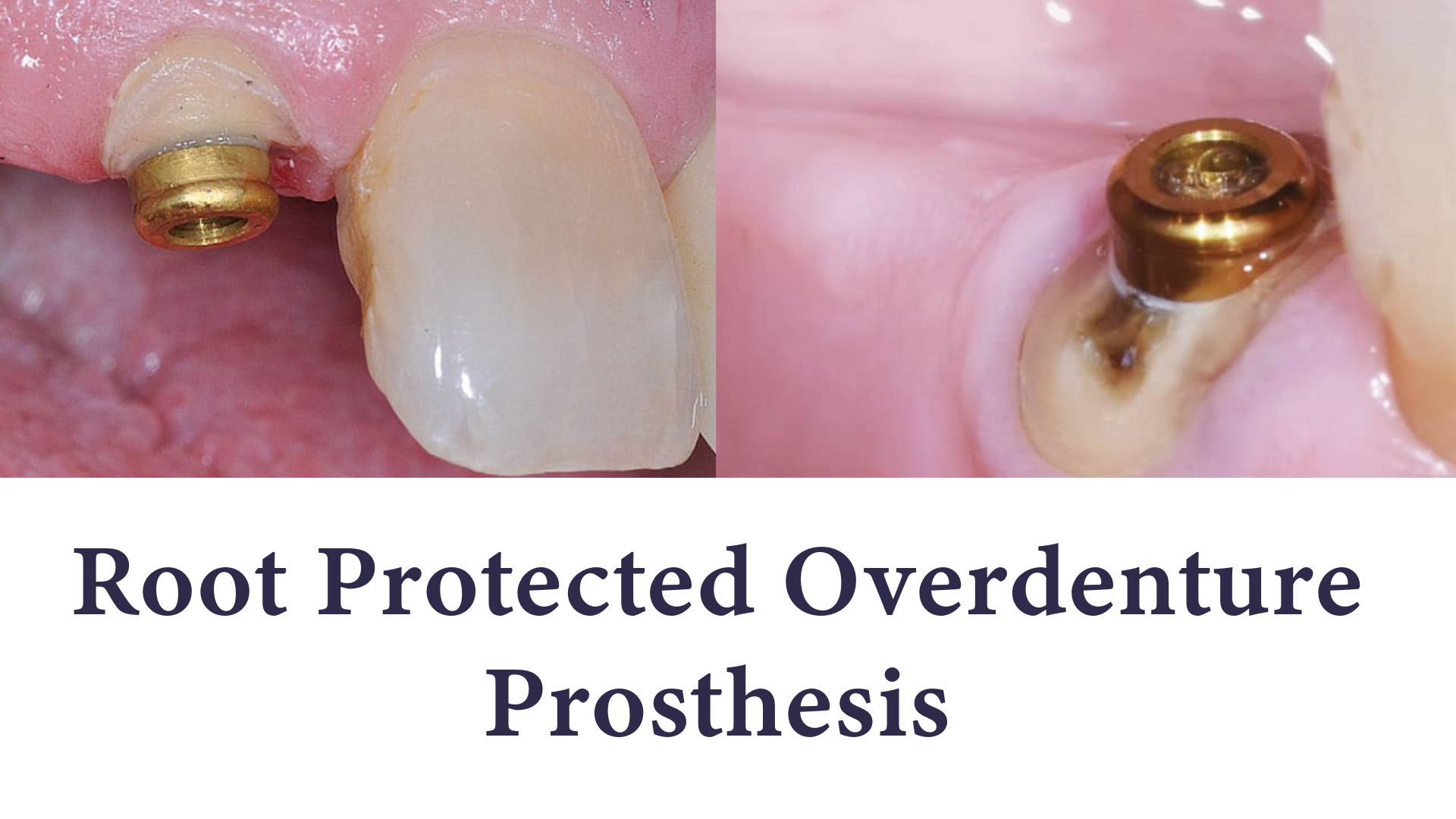 Root Protected Overdenture Prosthesis Root Protected Overdenture Prosthesis