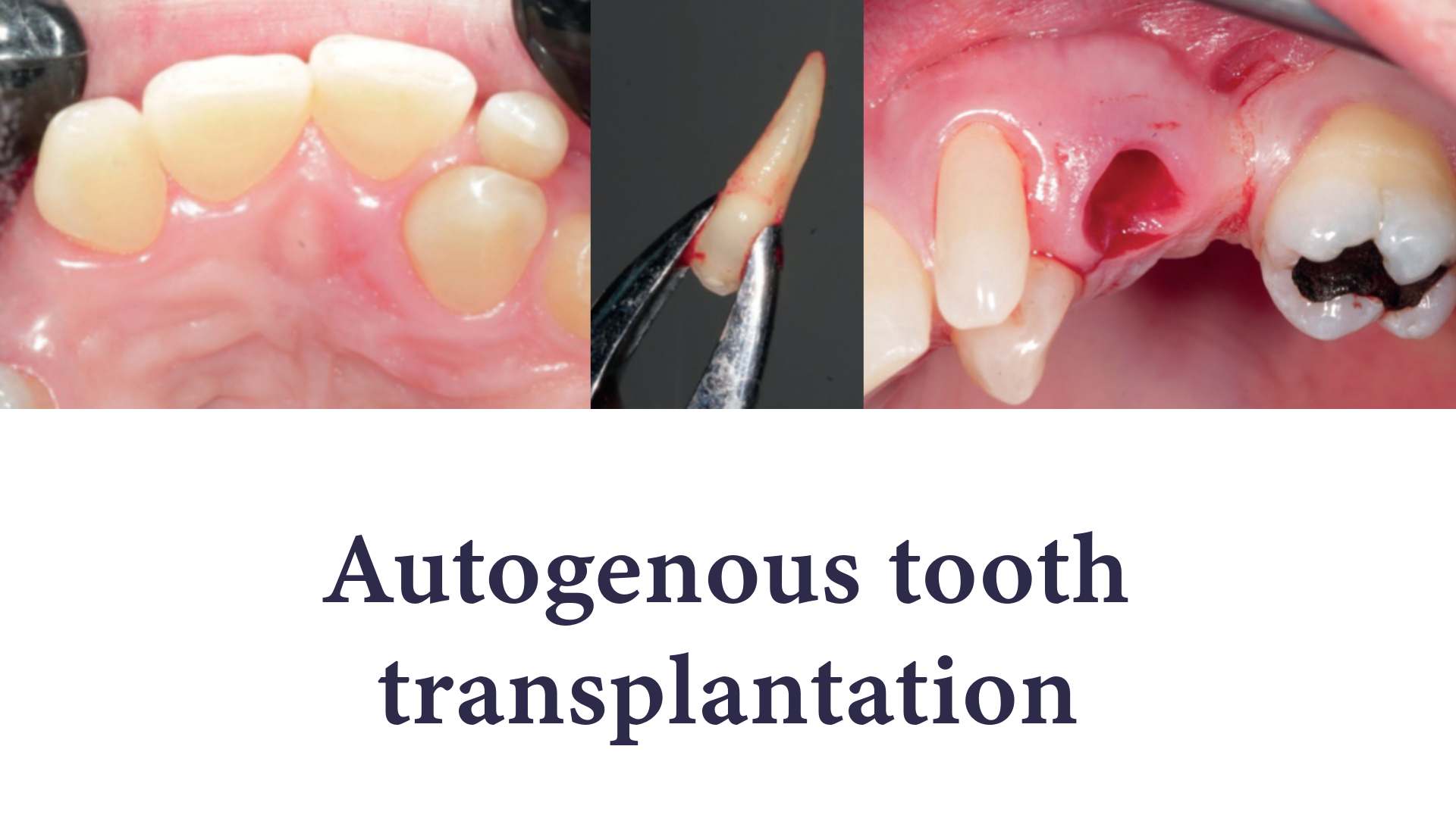 Autogenous tooth transplantation Autogenous tooth transplantation