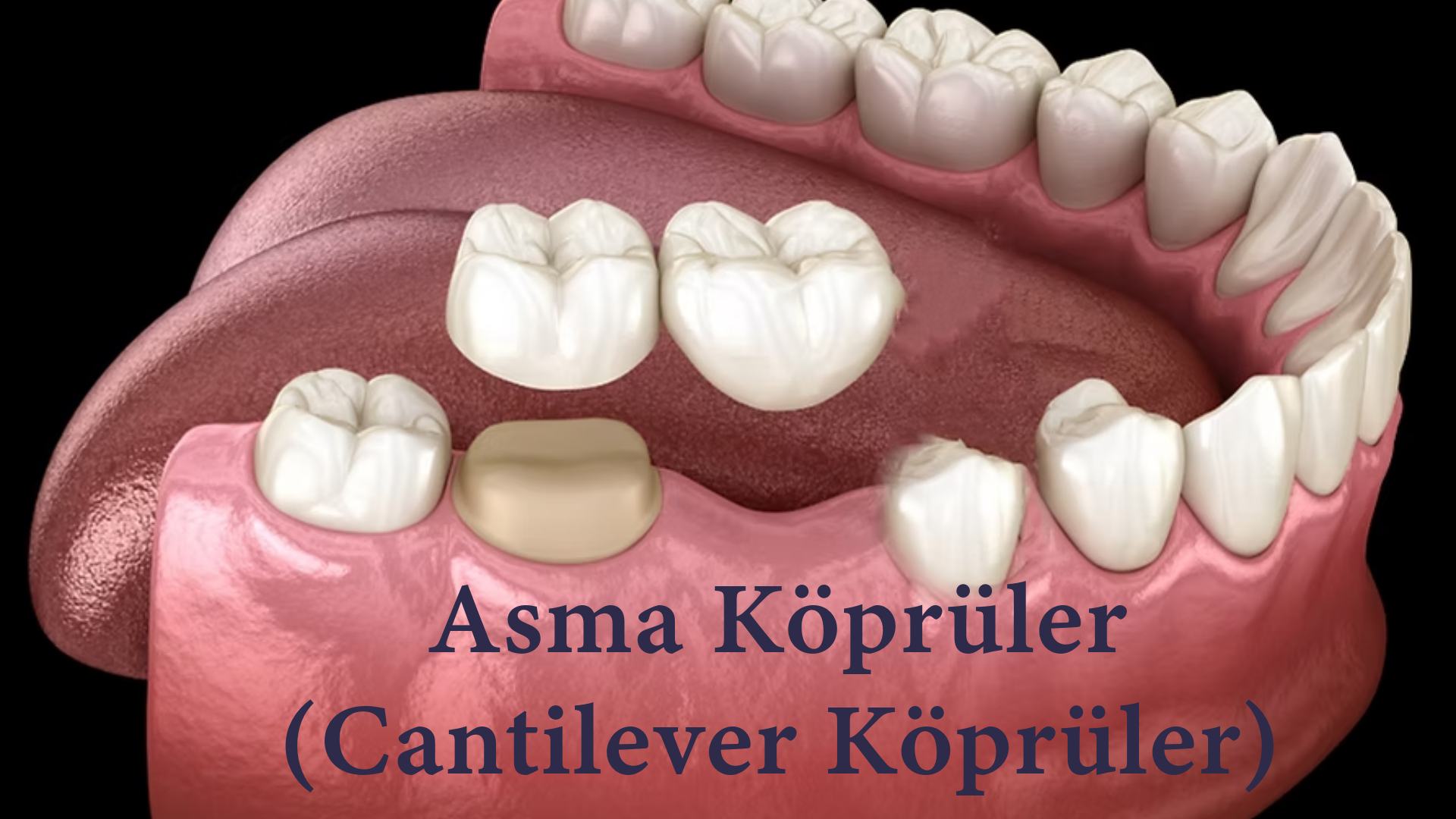 İmplant Tedavisine Alternatif Asma Köprü (Cantilever Köprü) Tedavisi - Antalya İmplant Tedavisine Alternatif Asma Köprü (Cantilever Köprü) Tedavisi Antalya