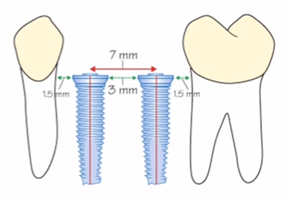 Sufficient Bone Level