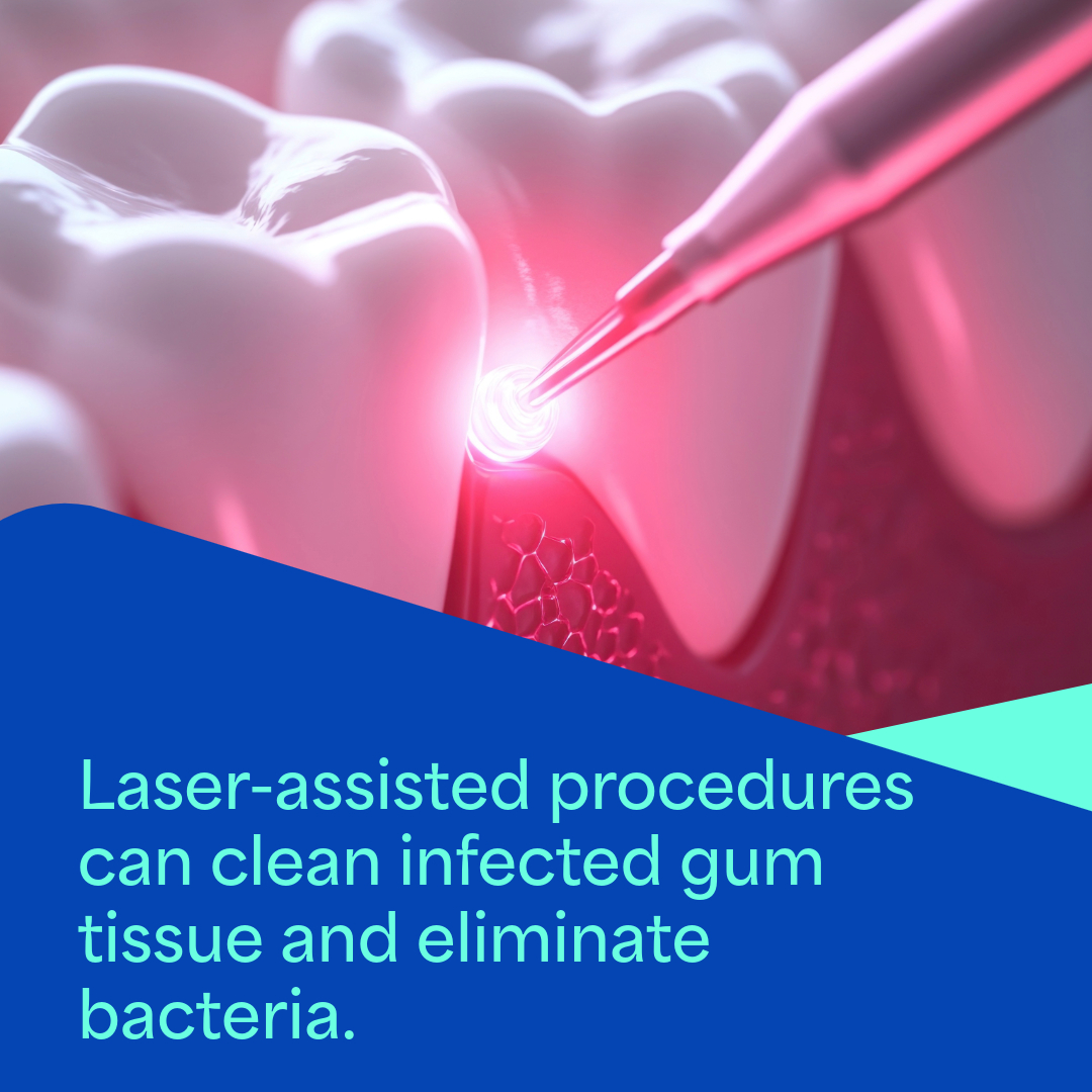 Laser treatment Laser treatment