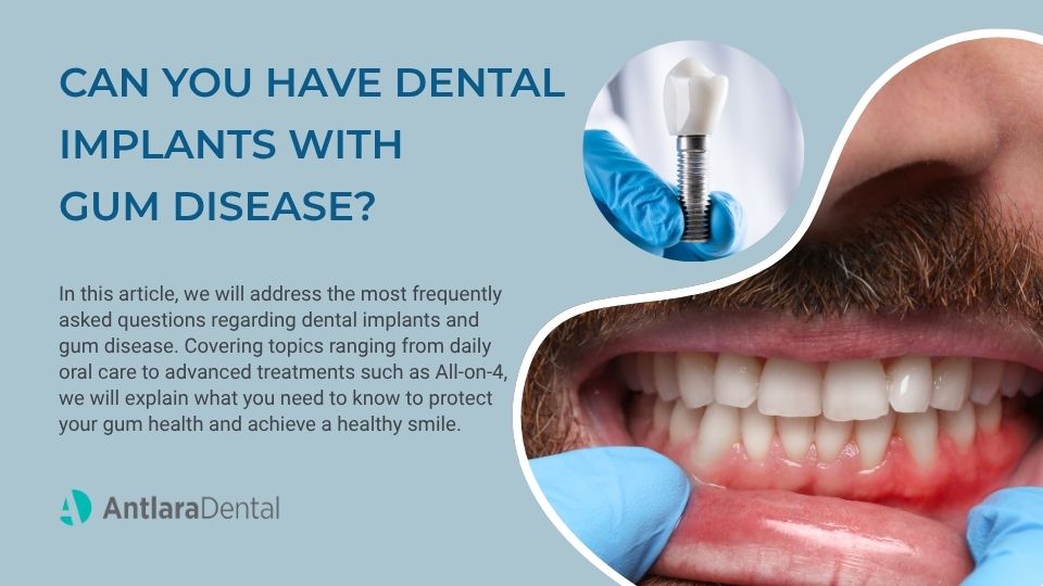 Can You Have Dental Implants With Gum Disease? Can You Have Dental Implants With Gum Disease?
