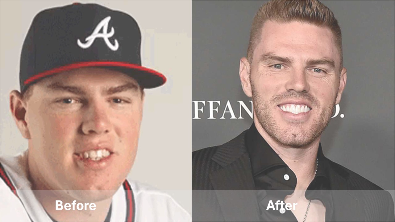 Freddie Freeman celebrities with teeth implants before and after Freddie Freeman