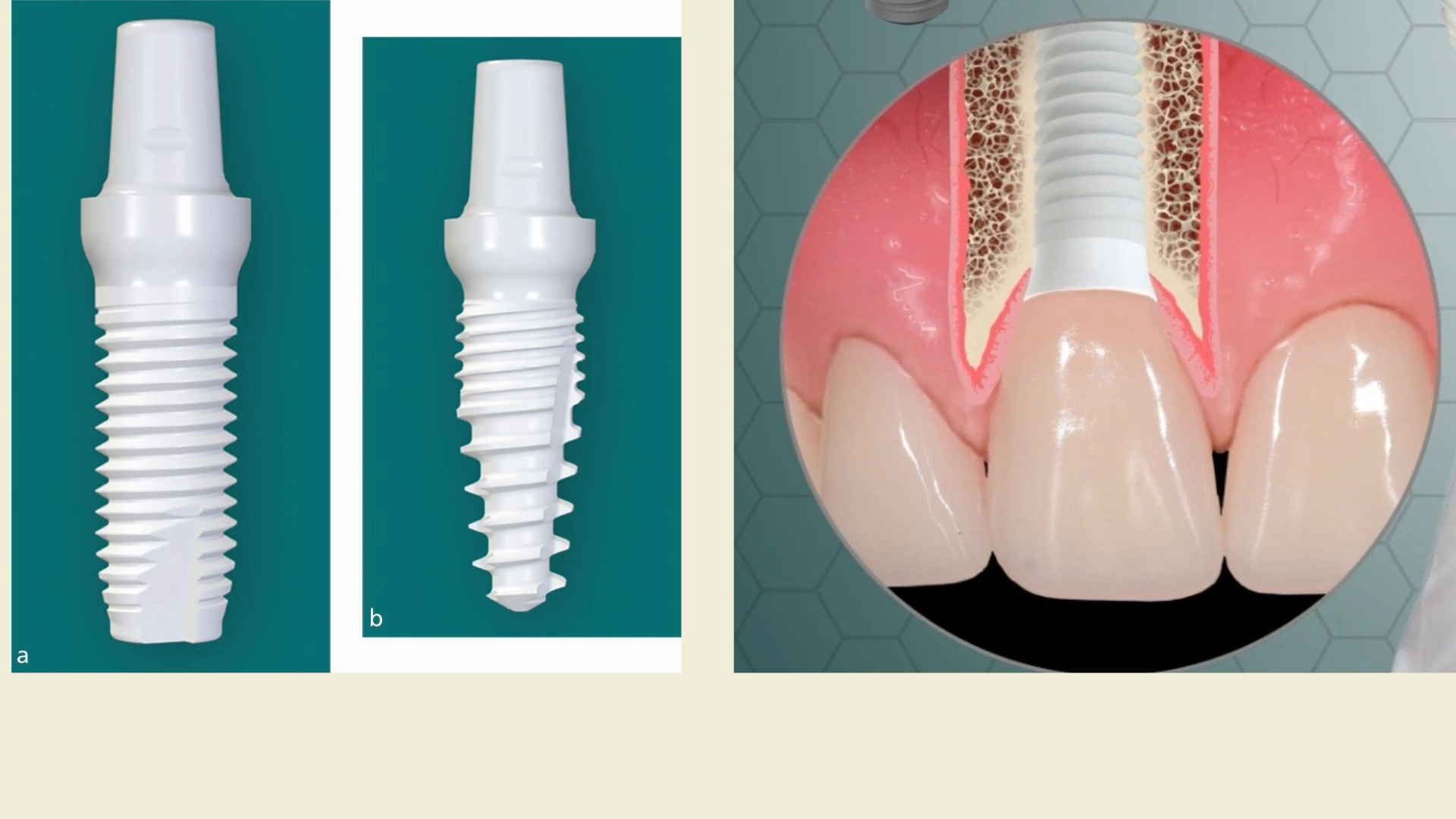 Structure of Ceramic Implants Structure of Ceramic Implants