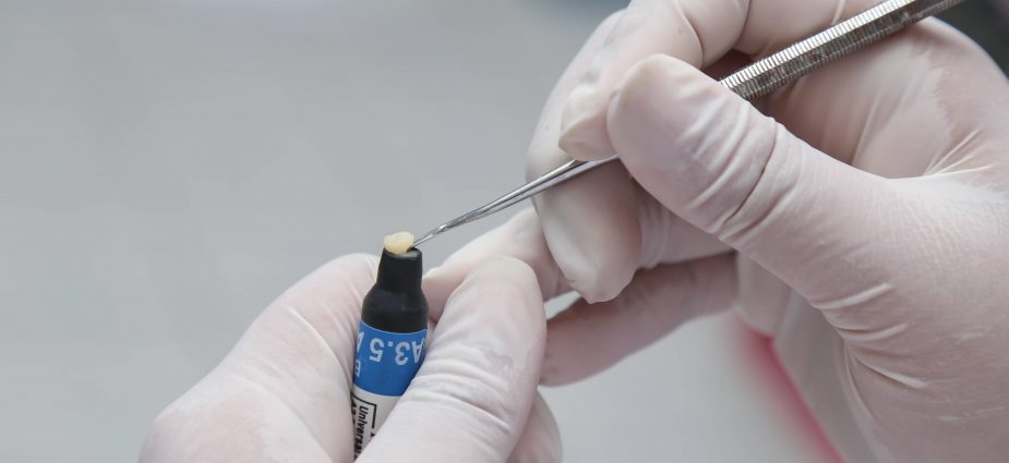 Composite Veneers: Application, Durability, and Maintenance Composite Veneers: Application, Durability, and Maintenance