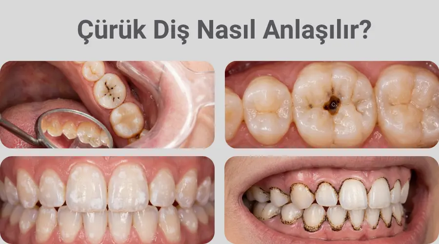Çürük Diş Nasıl Anlaşılır? Çeşitleri Nelerdir?