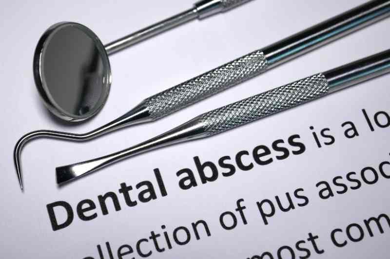 Tooth Abscesses Treatment Tooth Abscess Treatment