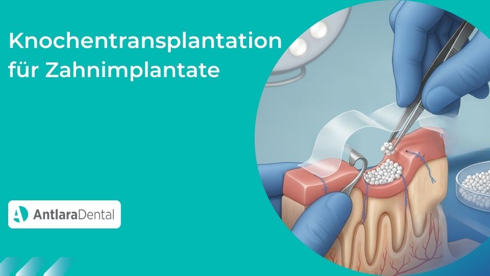 knochentransplantation-fur-zahnimplantate