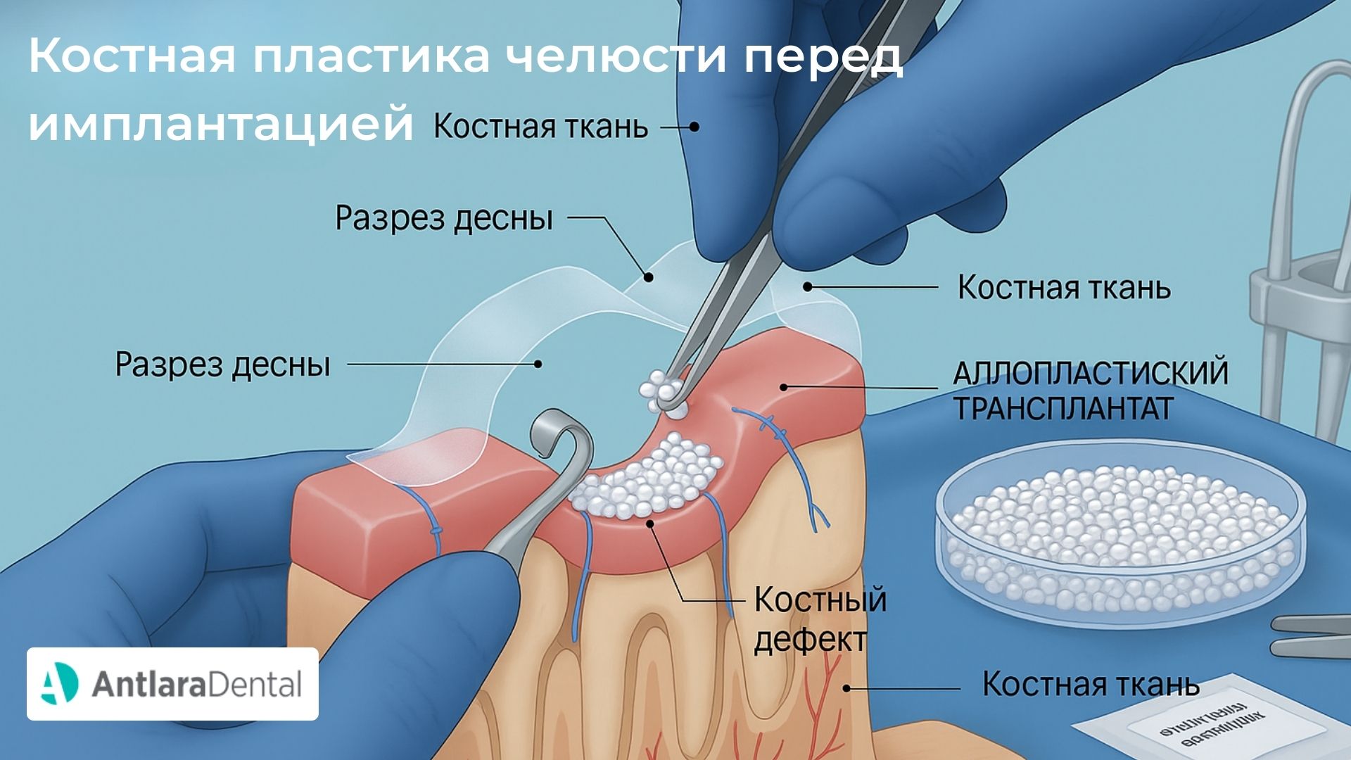  Костная пластика челюсти перед имплантацией  