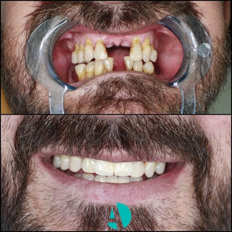 what does the implant look like what does the implant look like?