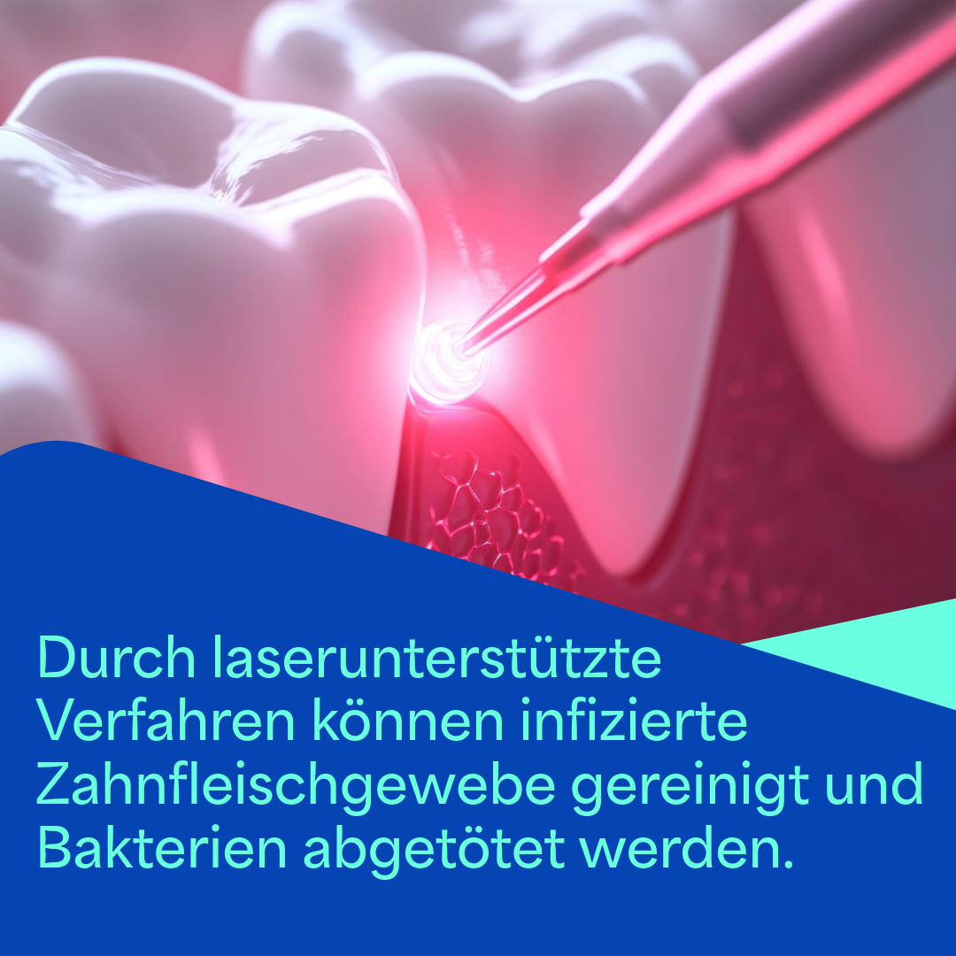 Laserbehandlung