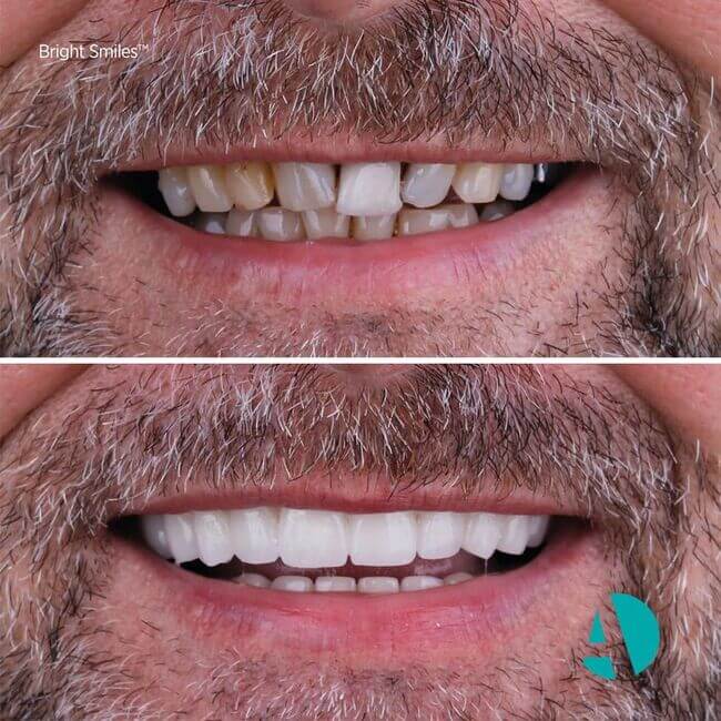 dental veneers before after image