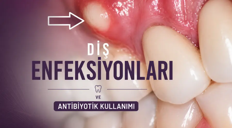 Diş Enfeksiyonlarında Antibiyotik Kullanımı | Antlara Diş Kliniği Antalya