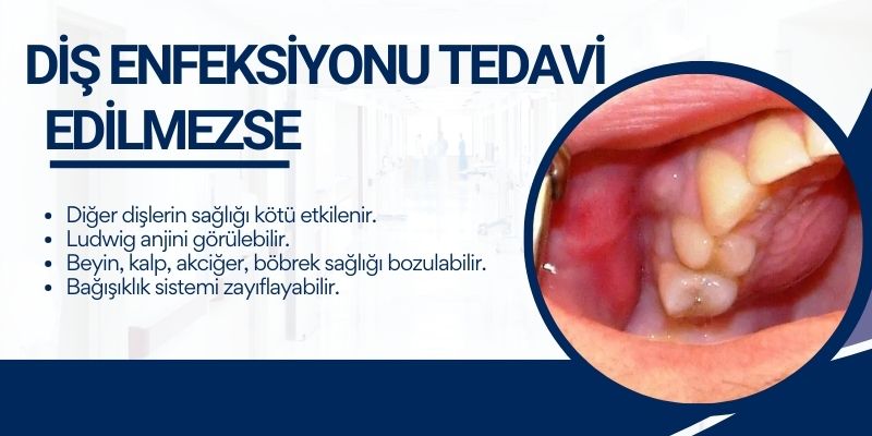 Diş enfeksiyonu tedavi edilmezse - Antalya Diş enfeksiyonu tedavi edilmezse - Antalya