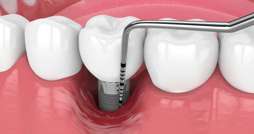 Diş Eti Çekilmesi varsa İmplant Yapılır mı?  Antalya