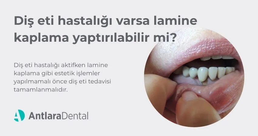 Diş eti hastalığı varsa laminate kaplama yaptırılabilir mi?  Antalya