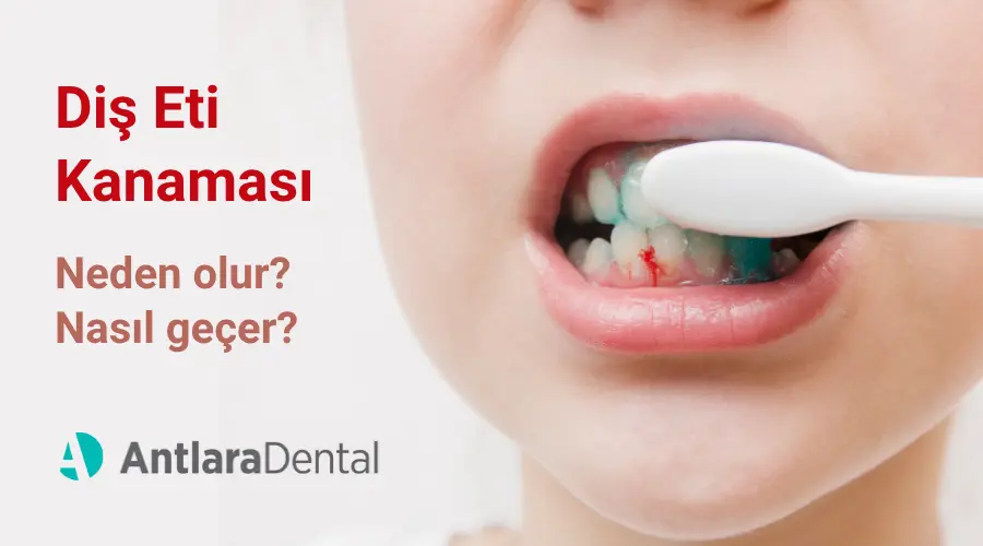 Diş Eti Kanaması Neden Olur?