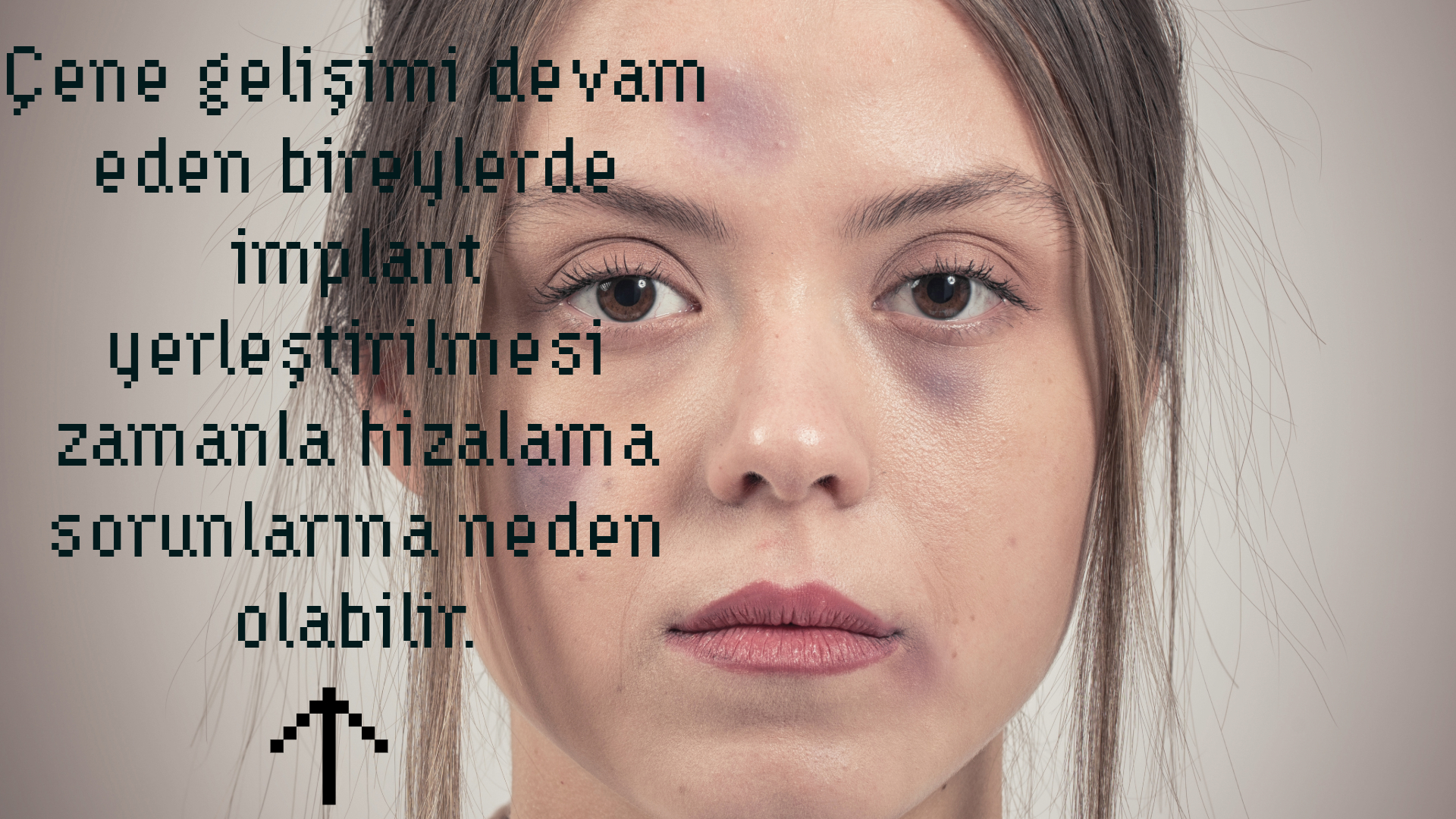 Diş İmplantı Kimlere Uygulanmaz? 10 Kritik Engel - Antalya İmplant Diş Öncesi Bu Uyarılara Dikkat! 10 Kritik Engel Antalya