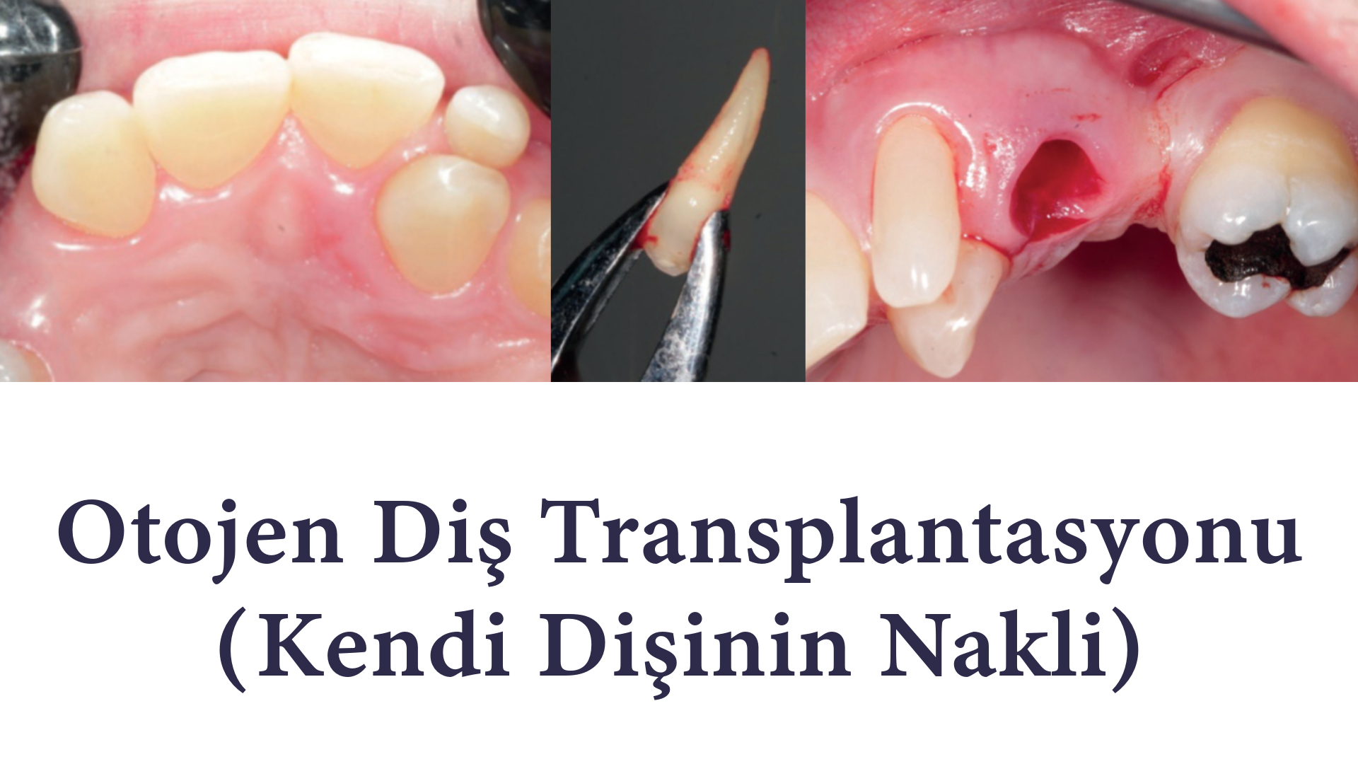 İmplant tedavisinin alternatifi otojen diş transplantasyonu (Kendi dişinin nakli) İmplant tedavisinin alternatifi otojen diş transplantasyonu (Kendi dişinin nakli)