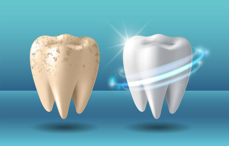 Diş Taşı-Tartar Oluşumu Nasıl Önlenir? Antalya