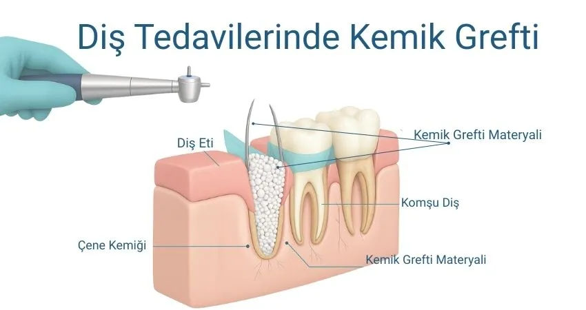 Diş Tedavilerinde Kemik Grefti - Antalya