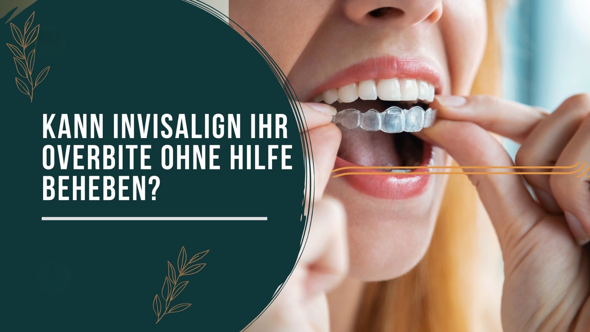 Kann Invisalign einen Überbiss korrigieren? 