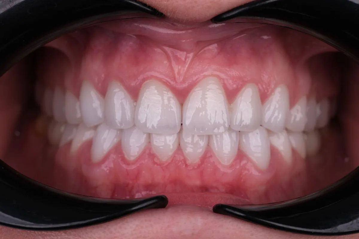 Finished e-max veneers on the upper and lower arch, retracted view