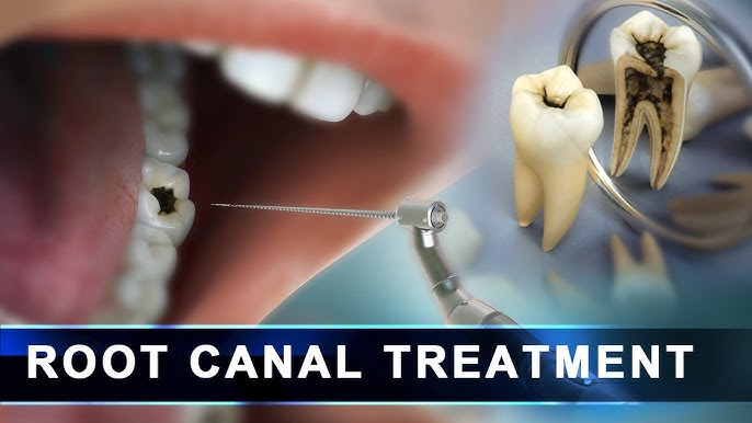 From decay to root canal treatment