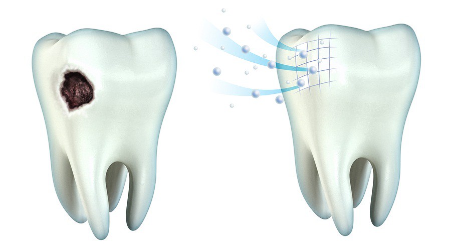 Can tooth decay be reversed?