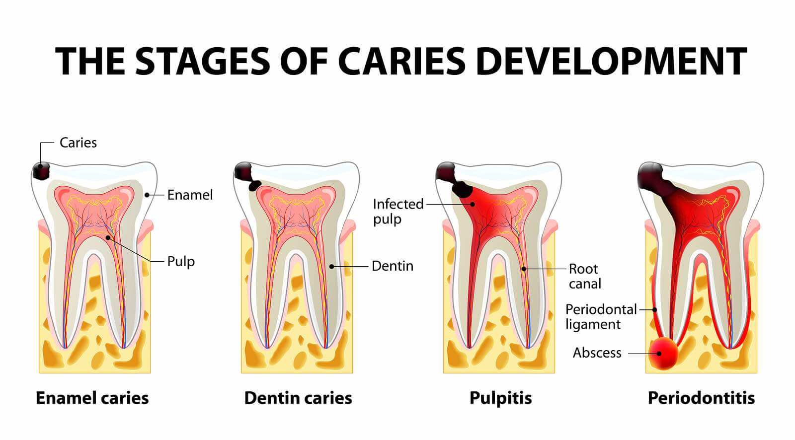 what does a decay tooth look like